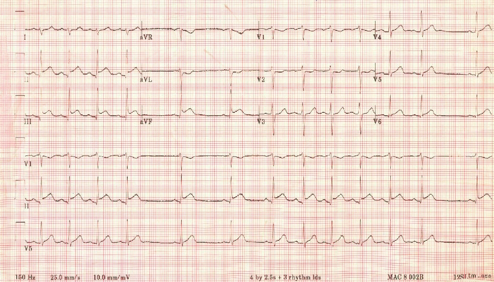 heart attack ecg. a heart attack at age 62.